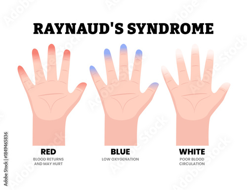 Raynaud’s Syndrome Hand Disorder Symptoms Medical Illustration. Showing color changes of fingers due to poor blood circulation. Dermatology. Vascular disorder with red, blue white color hand.