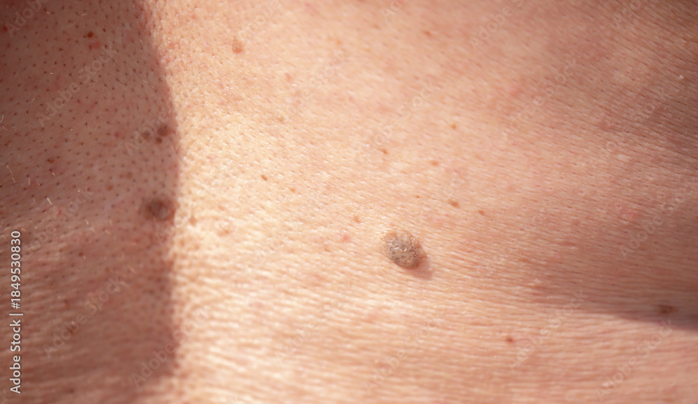 Fototapeta premium Nevus close-up. Mole on human skin. Irregular birthmark.