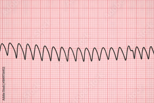 High-quality ECG rhythm strip showing ventricular tachycardia on graph paper, representing cardiac arrhythmia, emergency cardiology, heart rhythm disorders, and critical care monitoring.
