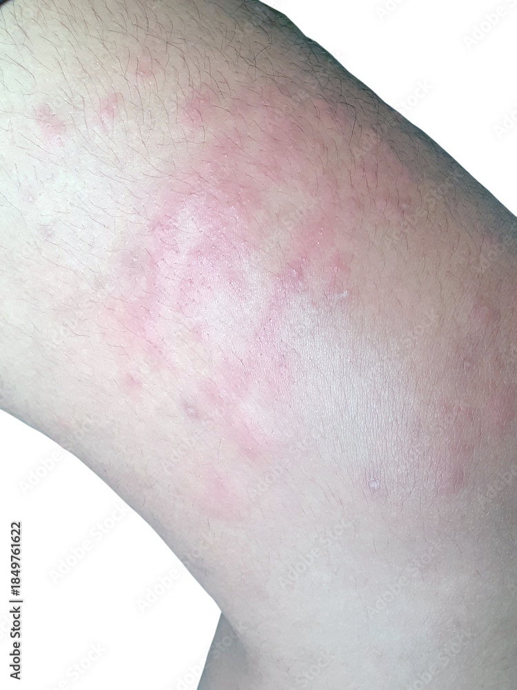 Naklejka premium Skin irritation on thigh from jellyfish sting with red rash and inflammation