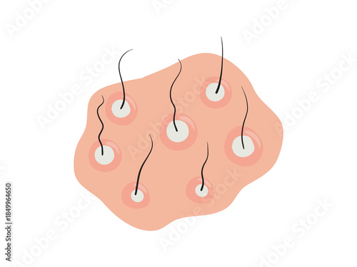 Folliculitis Disease in Skin Illustration