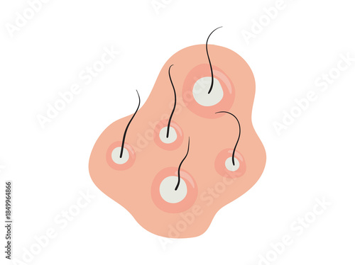 Folliculitis Disease in Skin Illustration