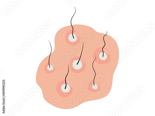 Hand Drawn Folliculitis in Scalp