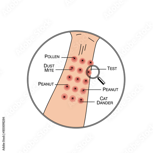 Skin allergy test with positive reactions to allergens on arm  