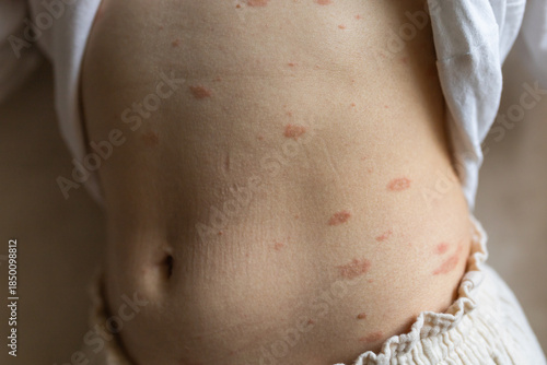 Pityriasis rosea (Gibert's disease) on the abdomen; tibiosis. Pink rosea is a rash on the body. An infectious disease caused by herpes.
