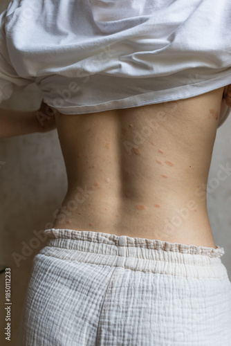 Pityriasis Rosea on the back. Skin rashes, infectious diseases.