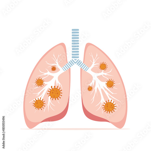 Human Lungs Illustration Affected by Viruses Healthcare Organ Anatomy and Medical Condition Disease Pathology  Respiratory System Infection