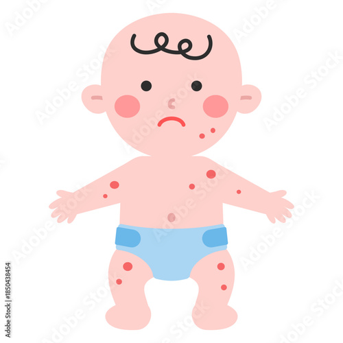 아기 몸 두드러기 일러스트