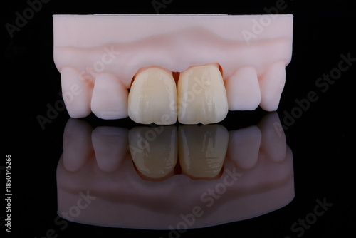 High-quality naturally dental single crowns made of zirconium for fixation to the frontal teeth of upper jaw.