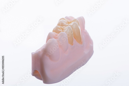 High-quality naturally dental single crowns made of zirconium for fixation to the teeth of upper jaw.