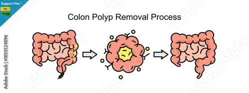 Colon Polyp Removal Process, vector illustration, icon color line.