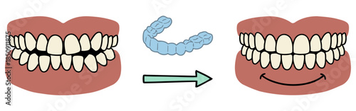 Teeth alignment before and after concept with invisible braces. Vector illustration of crooked teeth correction to perfect smile using clear aligners for orthodontic treatment.