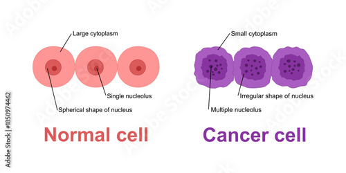 Cancer development. Normal cells are transformed into cancer. Carcinogenesis from Genetic mutations in healthy cell to Malignant cancer cells. Mutagenesis, Oncogenesis, tumorigenesis. Tumor formation