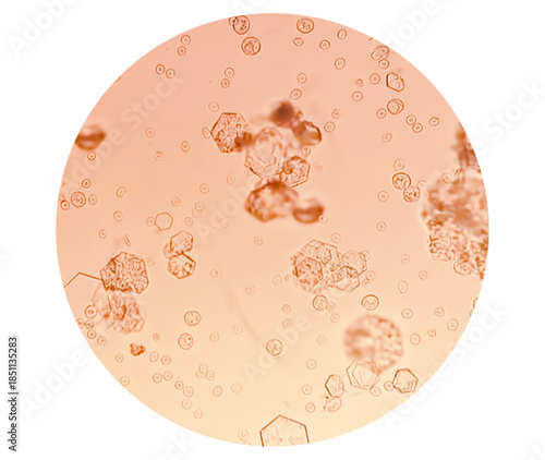 Cystine crystal in urine, type of kidney stone made from cystine chemical, rare disorder called cystinuria.