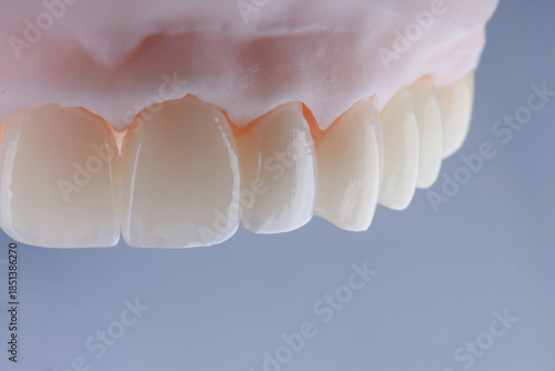 High-quality dental crowns made of zirconium for fixation to the teeth of upper jaw.