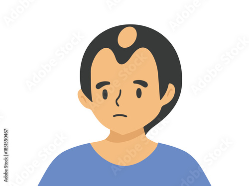 Male Androgenetic Alopecia Clip Art 
