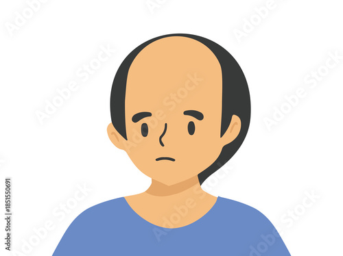 Androgenetic Alopecia in Hair Illustration
