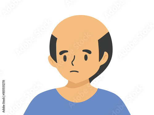 Androgenetic Alopecia in Hair Illustration
