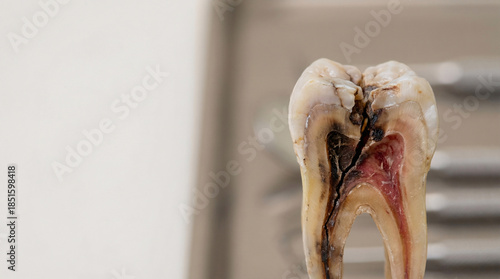 Tooth Fracture from Caries