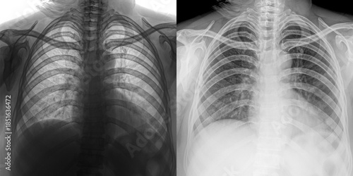 Chest Pa View X-Ray Image Displaying Pulmonary Anatomy and Lung Opacities for Evaluation of Pulmonary Anthrax Isolated on Transparent Background