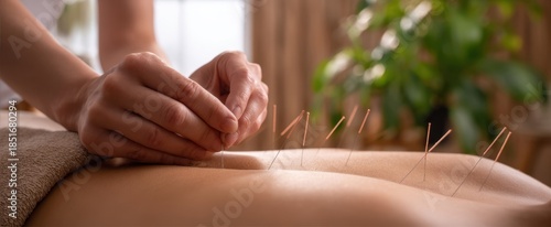 The Acupuncture Treatment Session Showing Needles Being Inserted into a Relaxed Back