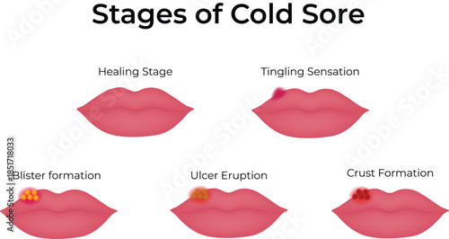 Cold Sore Progression A Visual Guide to Its Stages Vector Illustration
