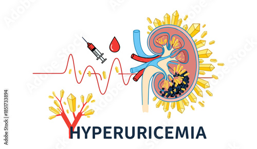 Hyperuricemia medical illustration with kidney, uric acid crystals, and blood test