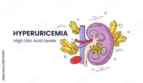 Hyperuricemia illustration with kidney and uric acid crystals concept.