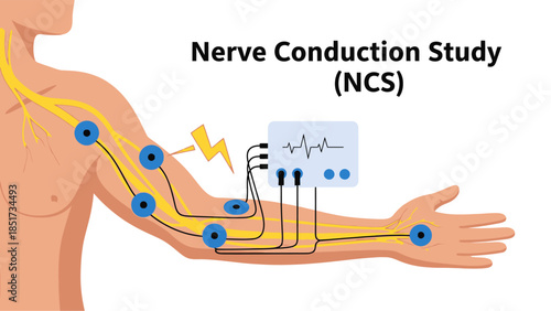 Nerve Conduction Study (NCS) medical procedure illustration