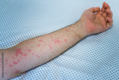 Allergic reaction rash on hand from medication side effect