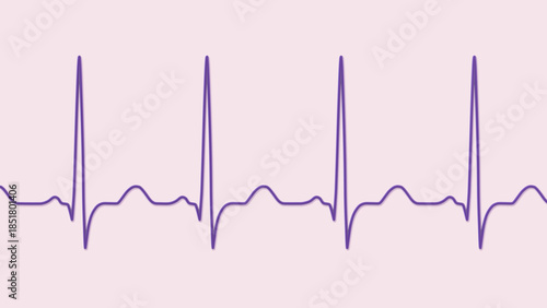Billede på lærred Sinus tachycardia, 3D illustration