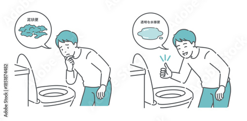 大腸カメラ前処置の便の状態比較イラスト（泥状便NG・透明な水様便OK）