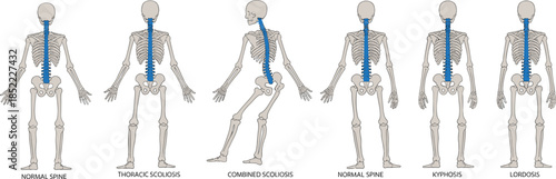 Medical illustration of six human spines showing normal alignment and spinal deformities including scoliosis, kyphosis, and lordosis for anatomy education.