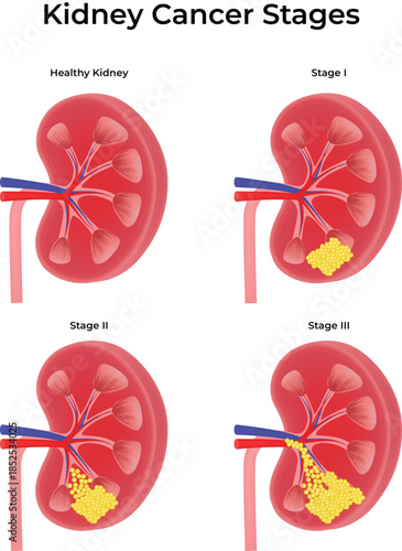 Kidney Cancer Stages Progression Diagram Vector Illustration