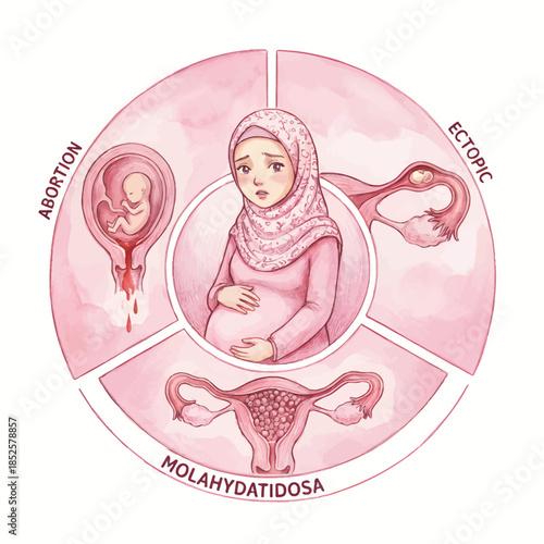 Illustration Of Pregnancy Complications: Abortion, Ectopic Pregnancy, And Molar Pregnancy 