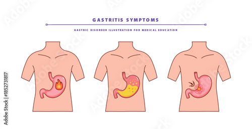 Gastritis Symptoms. Digestive Problem Stomach Illustration for Medical Education
