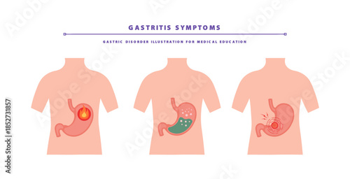 Gastritis Symptoms. Digestive Problem Stomach Illustration for Medical Education