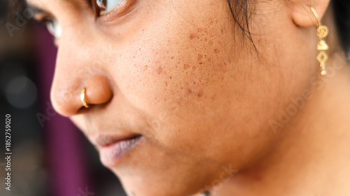 Quadro su tela Close-up side profile of Indian woman's face showing real skin texture with acne scars, open pores, and blemishes