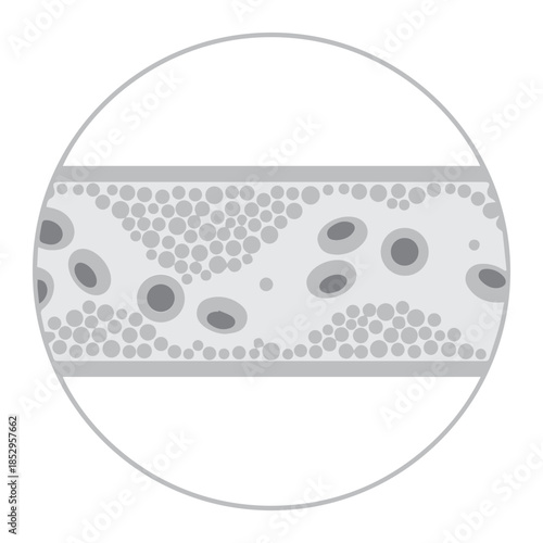 Vascular Obstruction Diagram