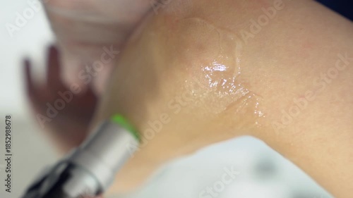 Close up vertical shot of woman arm during procedure of laser hair removal in modern cosmetology clinic. Concept of women beauty, cosmetology, epilation