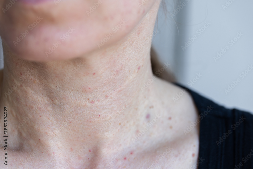 Fototapeta premium Female neck after beauty injections. Biorevitalization concept.