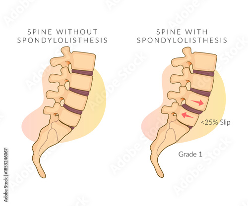 Spondylolisthesis grade 1- Spinal Joints - Stock Illustration