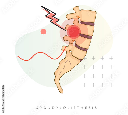 Spondylolisthesis grade 1- Spinal Joints - Stock Illustration