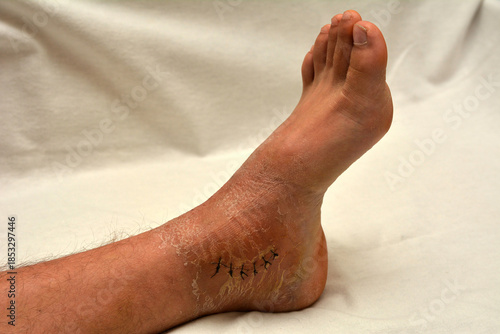 Foot injury with surgical stitches and medical dressing materials