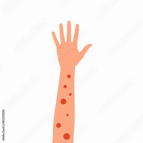 Illustration of a human arm with red spots indicating a skin rash or allergic reaction.