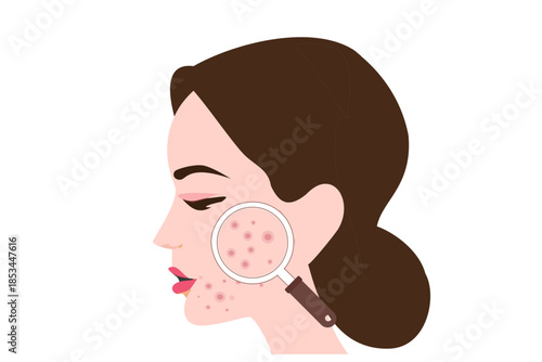 Dermatologist checking young woman face with skin acne, pimples, blackheads vector illustration. Acne skin face problem concept
