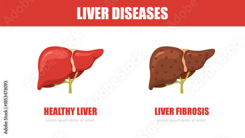 Liver disease. Healthy and fibrosis liver. Internal organ icons. Medical illustration. Vector design.