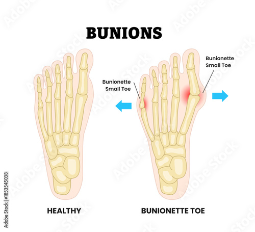 Healthy and bunion and bunionette as feet bone disorder condition. hallux valgus deformation disease. Big toe and foot connected joint. Medical education poster flat vector illustration.