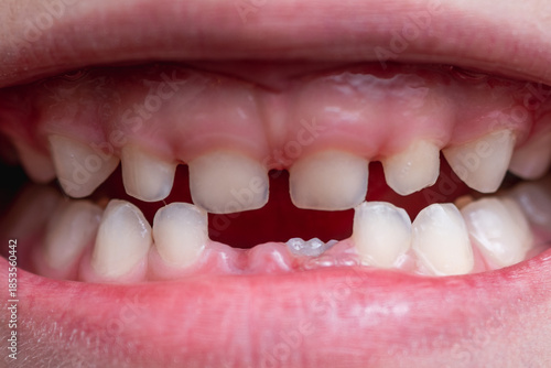 A child's smile with a gap between teeth, caused by lost front baby teeth. Dental development highlights the importance of oral health.