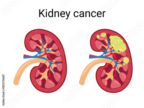 Stages of Kidney Cancer. Normal Kidney and Kidney with Cancer. Vector medical illustration
